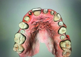 implantologia dentale computer guidata