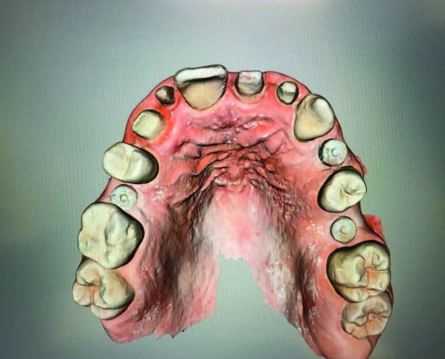 implantologia dentale computer guidata